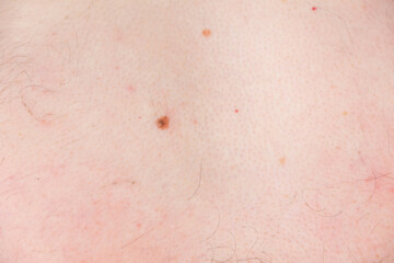 Mole, nevus on man's body before laser removing, closeup view. Man in clinic is preparing to laser removing of nevus, moles or papillomas.