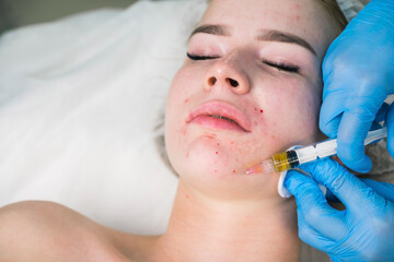 PRP therapy in beauty clinic. Cosmetologist is doing injections of blood plasma to womans face to cure problem skin, closeup top view. Treatment of skin in cosmetology for young female.