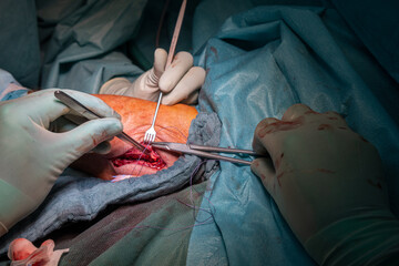 in operation an elbow fracture is treated by doctors with a titanium plate