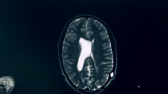 MRI scan of a human brain in motion
