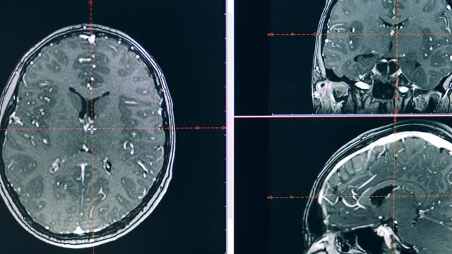 MRI scan of a patient's brain is getting explored