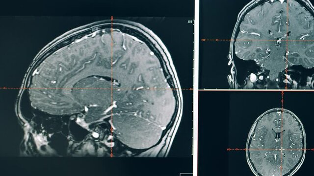 Scanning of brain's magnetic resonance image