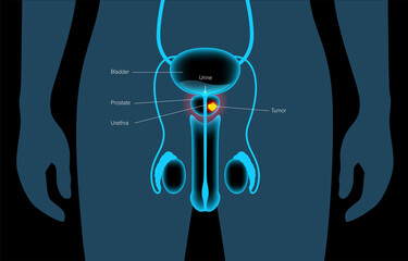 Prostate cancer concept