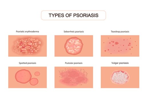 Varieties of psoriasis set. Red eruptions on skin with ulcers and itching damage upper layers of epidermis with allergies severe neurological disease with pustular abscesses. Pathological vector.