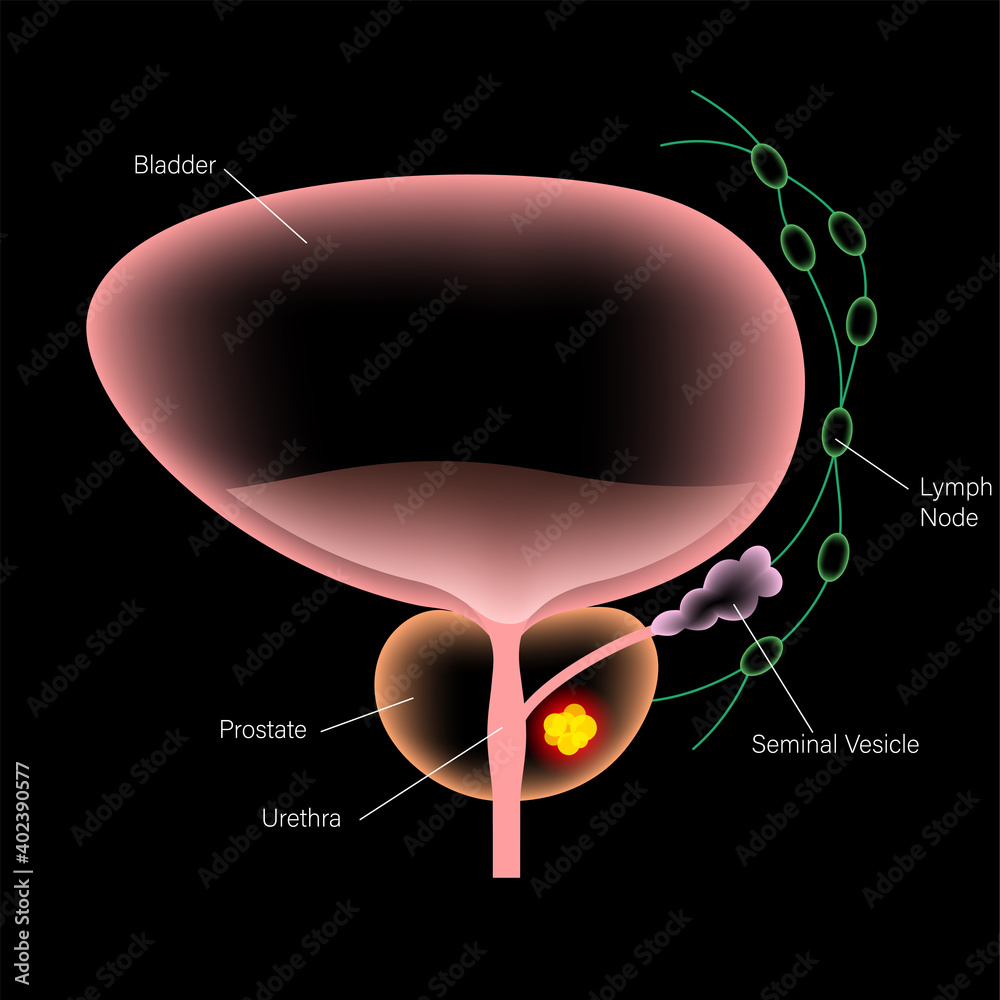 Canvas Prints Prostate cancer concept