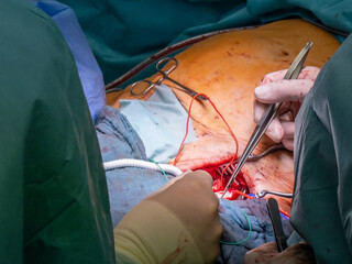  vascular surgeon sews in an artificial tube prosthesis as a bypass for a blocked leg artery