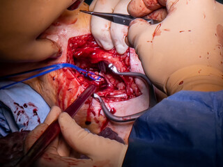  vascular surgeon prepares a leg artery for bypass surgery