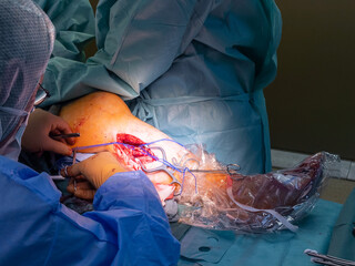  vascular surgeon prepares a leg artery for bypass surgery