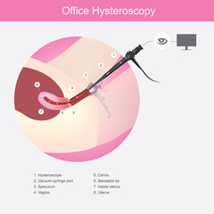 Office Hysteroscopy. Illustration showing the doctors use a micro camera (hysteroscope) insert passed a vagina into the uterus for diagnosis symptom..