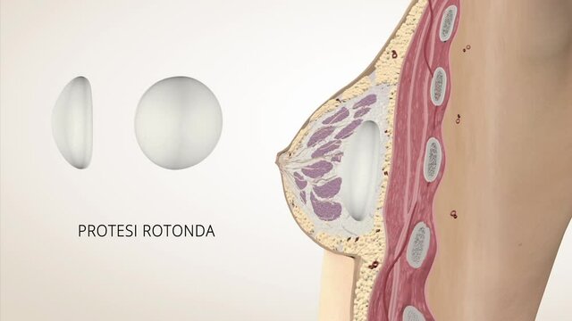 Impianto protesi mammaria 3D
