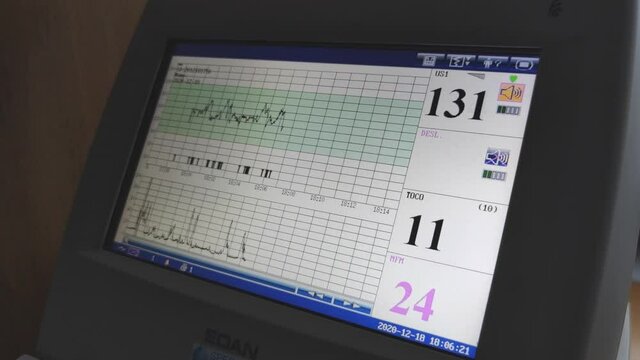 Cardiotocograph machine in a hospital CTG monitoring equipment showing result of heartbeat and pulse.

