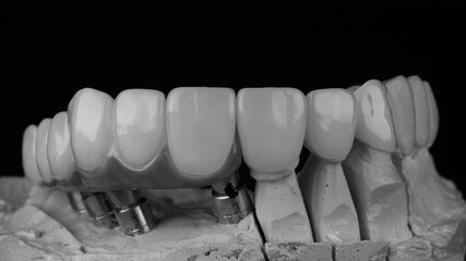 black and white photo of a dental bridge made of ceramic of the upper jaw © Dental Pro Content