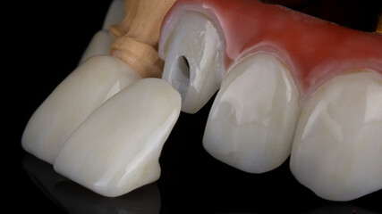 hybrid dental prosthesis with ceramic veneers on black glass