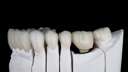 dental veneers and ceramic crowns on a model on a black background