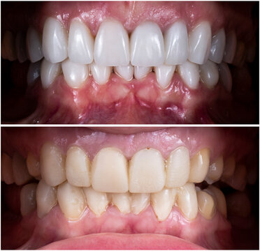 before and after picture after fixing 20 unit emax press ceramic veneers