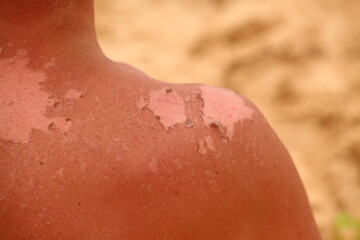 Fototapeta premium sunburn skin on the back of a man