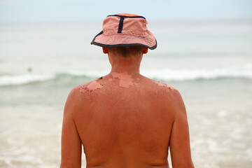 sunburn skin  on the back of a man