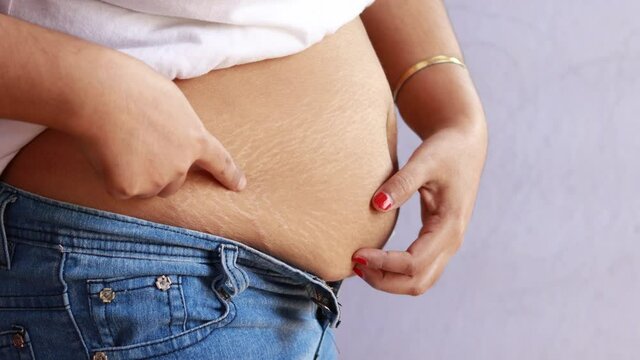 belly fat an stretch marks - woman