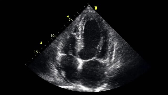 Transesophageal ultrasound video in gray-scale mode.