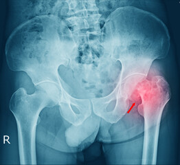 film x-ray a male pelvis fracture and arthritis at left  hip joint