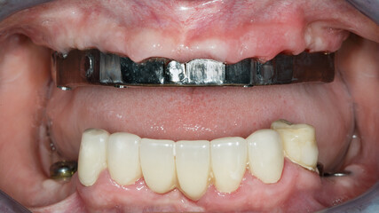 dental titanium bar of the upper jaw in the patient's gum cavity © Dental Pro Content