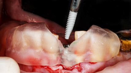 implant and implantation through the guide for high precision of the lower jaw