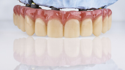 excellent dental prosthesis with pink gum of the upper jaw on a white background © Dental Pro Content