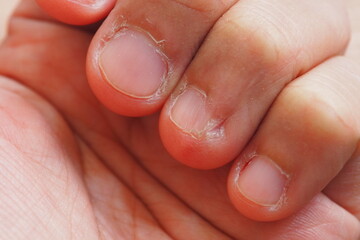 Closeup of deformed nails from human nail biting behavior Medical and healthcare concept 