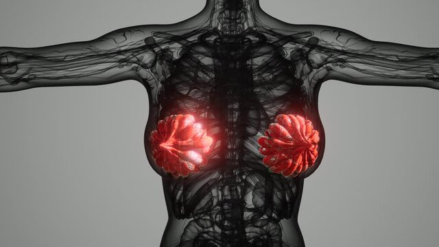 medical scan of Woman Breast Cancer