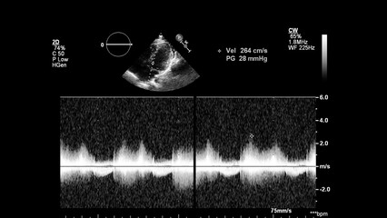 Image of the heart in gray-scale mode during transesophageal ultrasound.