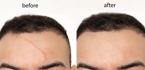 Comparison of Before and after scar revision (treatment ) using laser , led and creams on a man's forehead (face) - obrazy, fototapety, plakaty