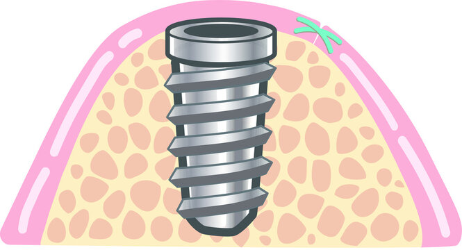 47 Best インプラント治療 Images Stock Photos Vectors Adobe Stock 47 Best インプラント治療 Images Stock Photos Vectors Adobe Stock