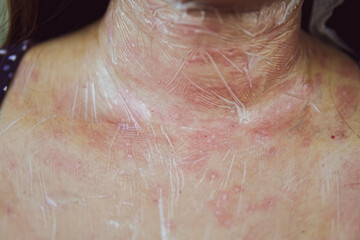 close up of skin of women after laser removal wrinkles.