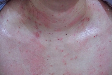 Fototapeta premium close up of skin of women after laser removal wrinkles.