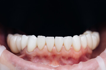 Veneers after fixation. Natural color. Cosmetic dentistry veneers. Modern dental equipment and installation procedure of veneers in dental clinic