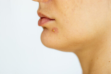 woman with "maskne" - mechanical acne caused by wearing a mask against covid-19 contamination. Maskne occurs when sweat, oil and bacteria get stuck on your skin.