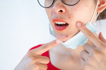 Woman pointing acne Inflamed occur on her face after wearing mask for long time during covid-19...