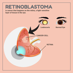 Medical illustration of Retinoblastoma, eye cancer