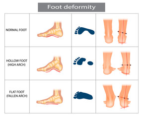 Foot deformation. Types pathologies of foot. Hollow, flat and normal foot.
