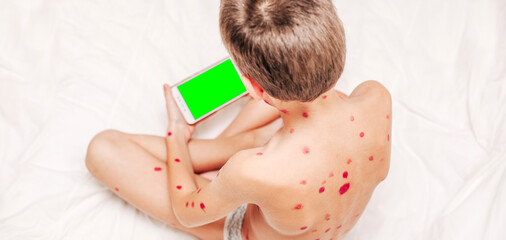 A small child with a chicken virus sits on the bed and plays on the phone. Varicella virus. A place...