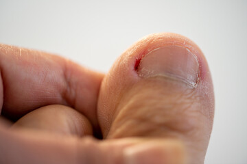 Closeup the ugly skin wound from ingrown toenail problem on woman toe nail after self pedicure
