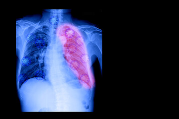A chest X-ray indicates inflammation of the lungs and respiratory system.