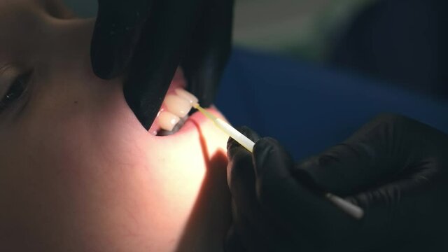 Doctor hygienist applying fluoride to teen teeth with cotton swab in dentistry. Covering using fluoride gel. Cure concept. Dentist making fluoridation child boy teeth after cleaning for protection.