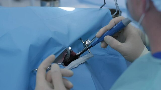 Operation to remove tonsils. In modern clinic under deep anesthesia, using latest devices patient removes glands, cold plasma method, cuts swelling in throat, doctor works with new probe