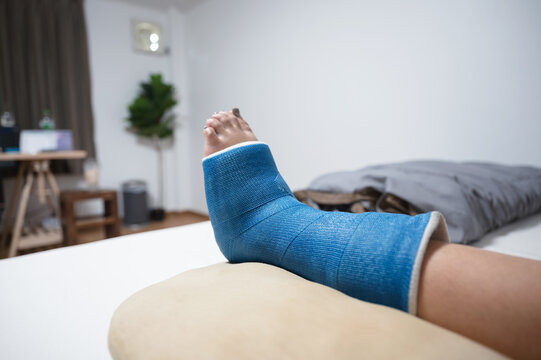 Woman accident with bone fracture foot in plaster cast resting on the bed