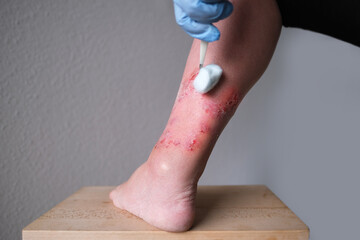 doctor treats a large healing wound from on lower leg with scars of adult female patient, redness,...