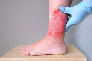 doctor treats a large healing wound from on lower leg with scars of adult female patient, redness,...