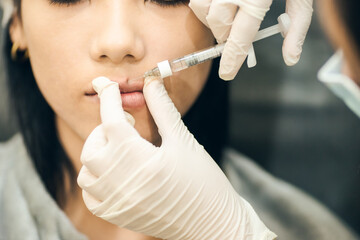 Closeup syringe on hand of Surgeon, Procedure lip augmentation. Beauty Asian woman surgery filler...