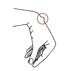 Simple vector black outline drawing. Hygroma on the wrist joint. Subcutaneous formation on the hand. Medicine and health, surgery.