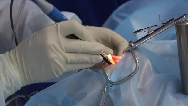 Doctor Operates on Patient. Close-up. Removal of Growths in Oral Cavity. Operation Cold Plasma. Manipulator. Hands in Gloves. Open Mouth. Real Operation. New technologies. Operating Room. Health Care